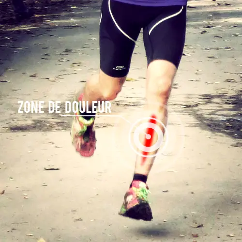 La periostite tibiale, blessure courante du coureur running