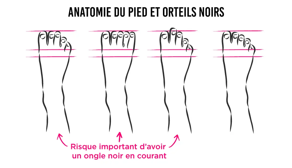 Ongle noir en course à pied : Que faire ? Et comment l'éviter ?