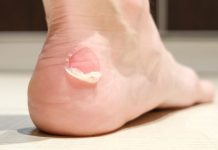Ampoules en course à pied : Comment les éviter / les traiter ? Ampoules en course à pied : Comment les éviter / les traiter ?