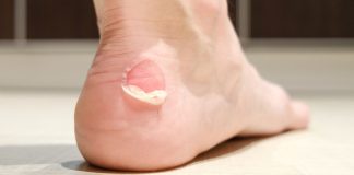 Ampoules en course à pied : Comment les éviter / les traiter ?